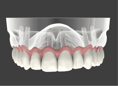 Dental Implant Loveland, CO