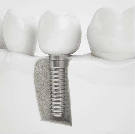 Loveland, CO Implants